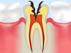 C3：神経の虫歯