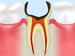 C4：歯根の虫歯