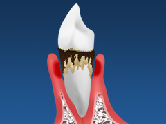「静かなる病気」歯周病の恐さ