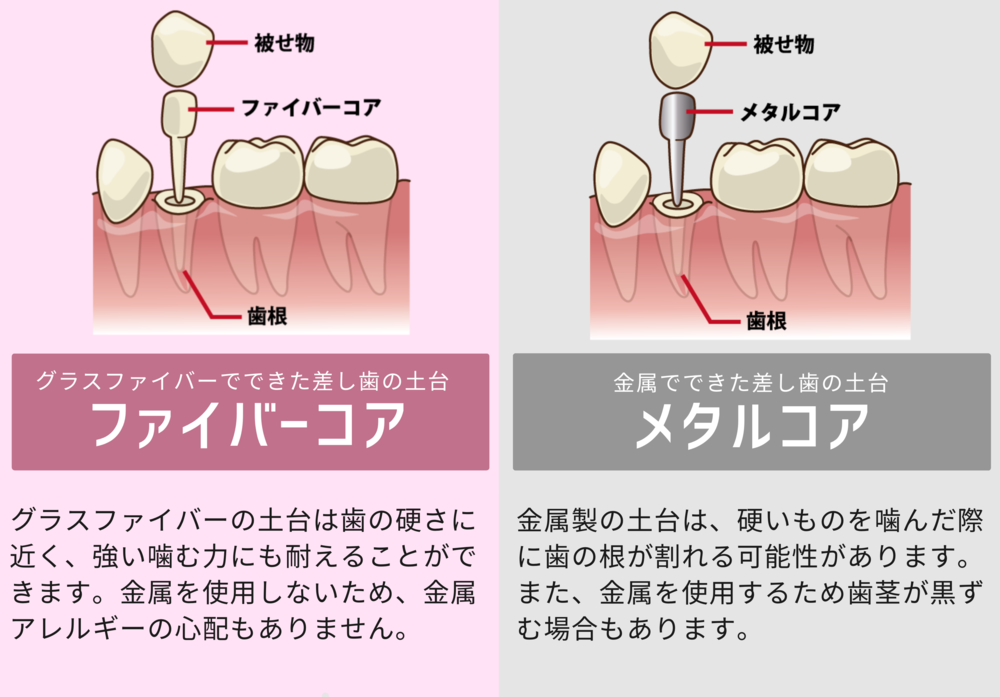 被せ物の土台「ファイバーコア」